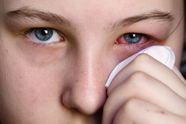 Pink Eye (Conjunctivitis)